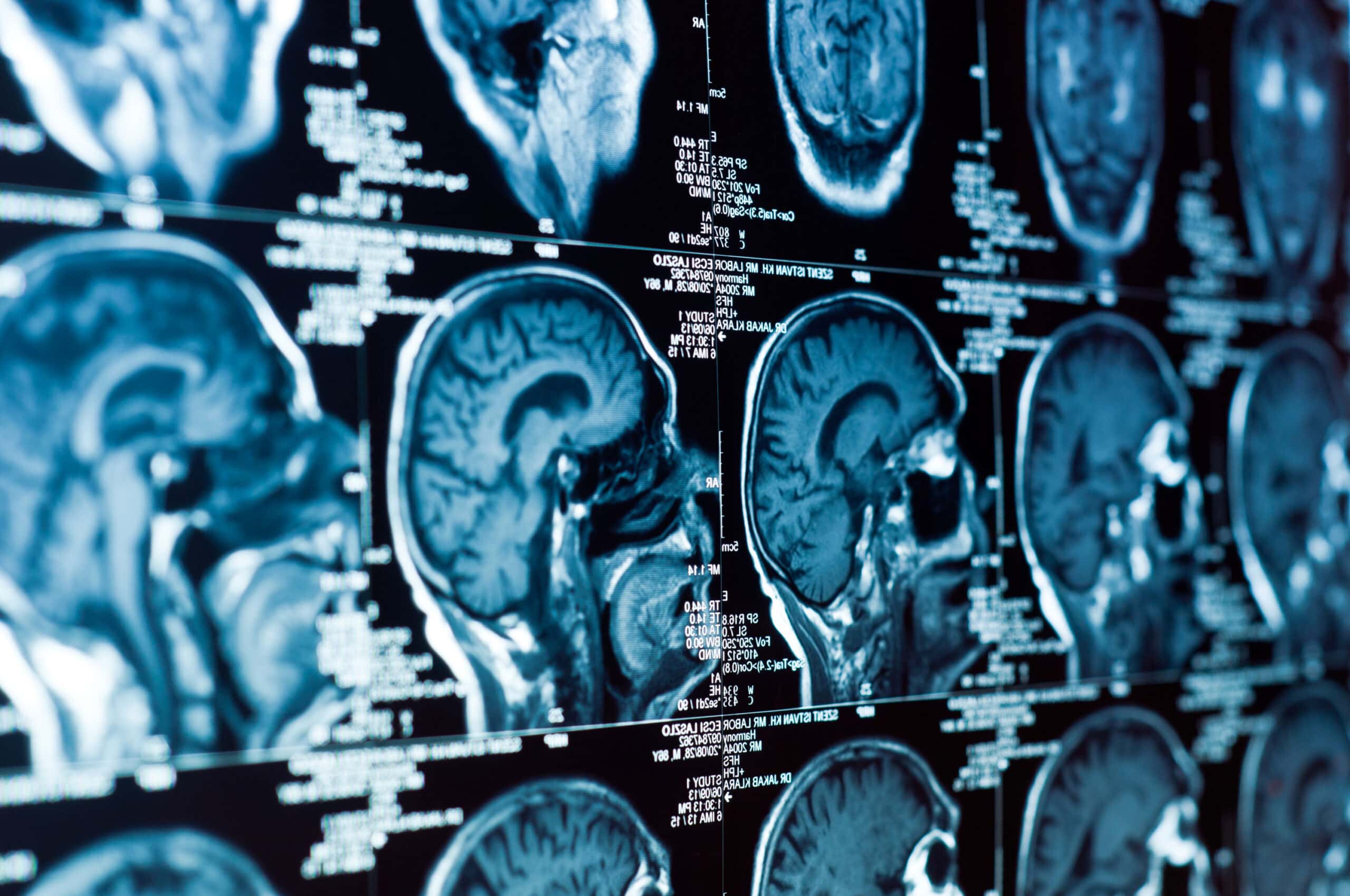 Dijagnostika plavi MRT mozga